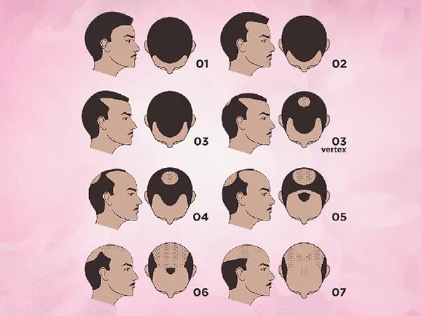 Requirment Of Graft As Per Area Of Baldness