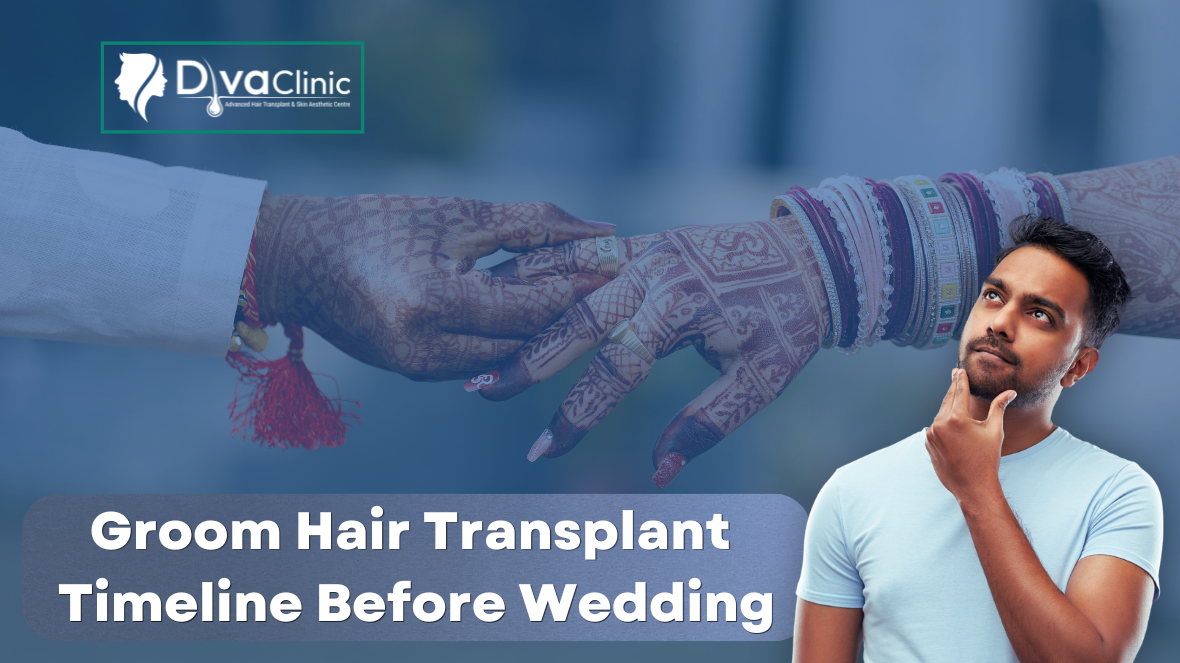 Groom hair transplant timeline before wedding with wedding couple background and thoughtful man, promoting hair restoration treatment at DvaClinic.