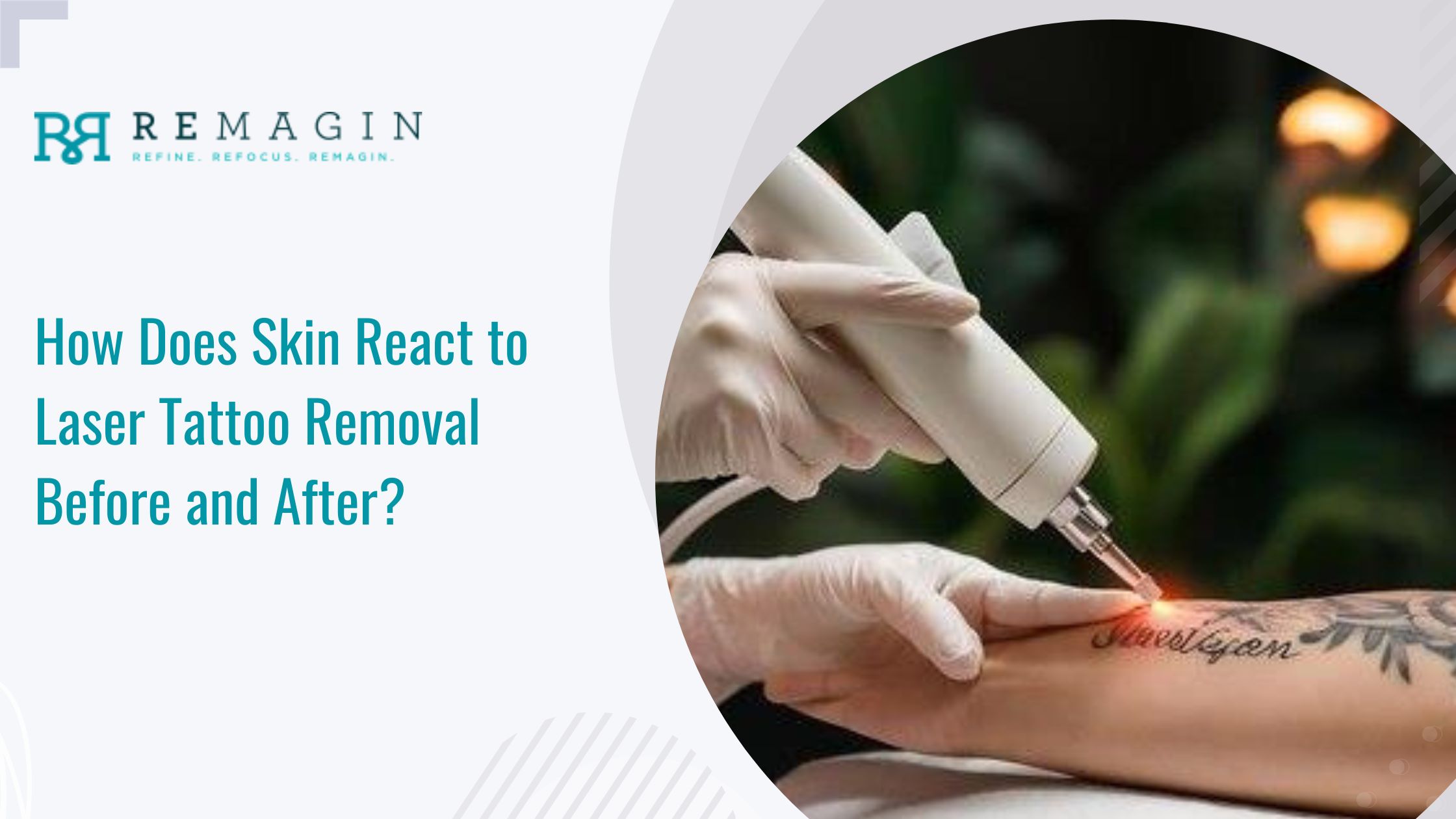 Laser Tattoo Removal Before and After | Remagin