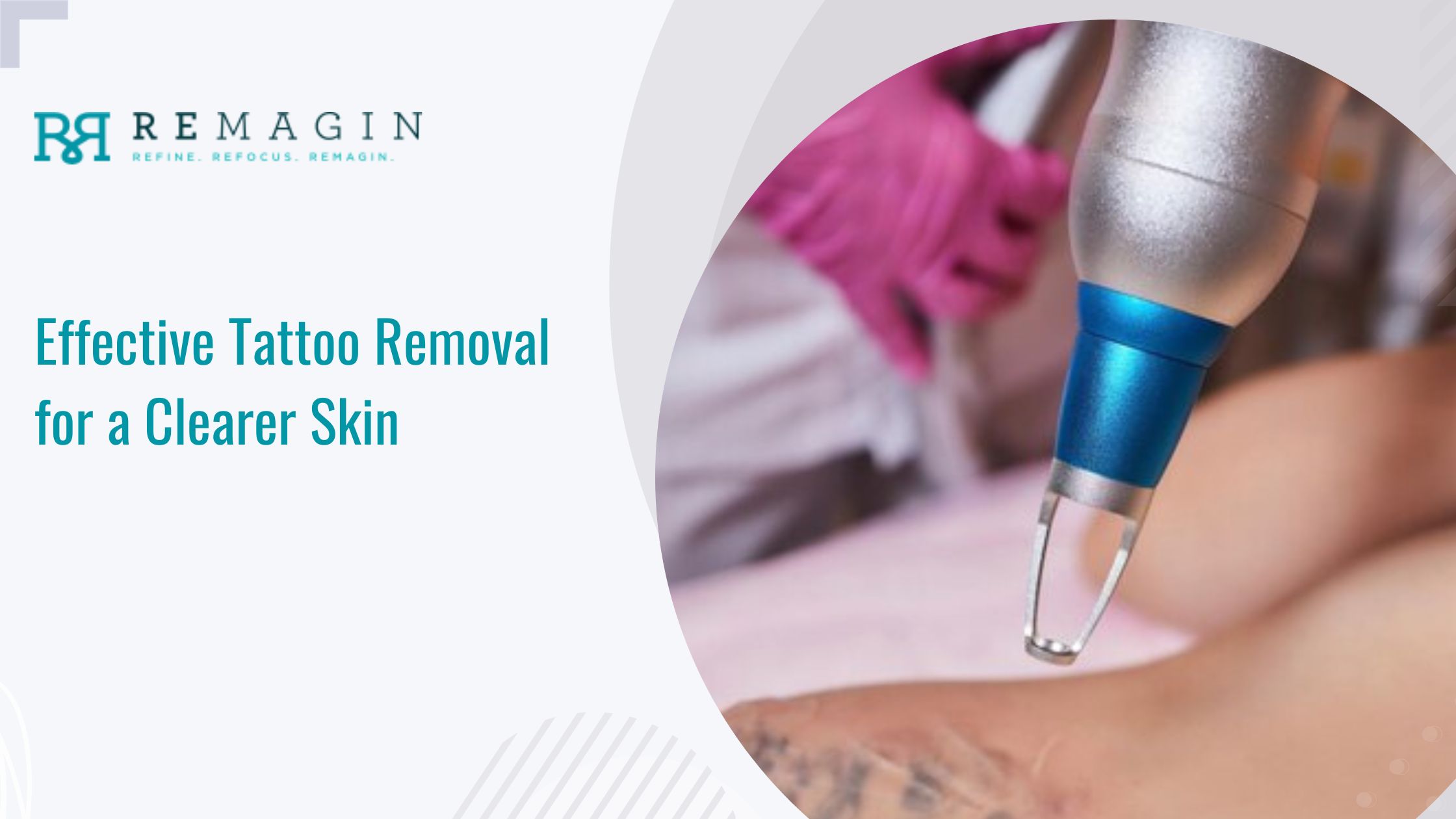 Effective Tattoo Removal for a Clearer Skin