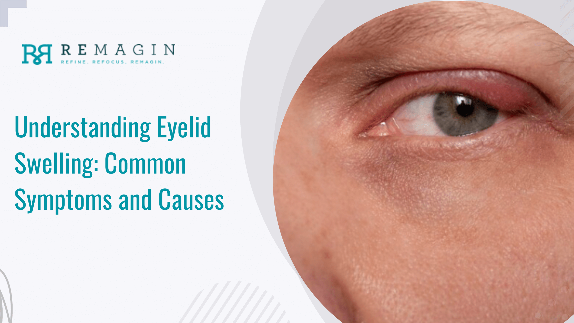 Understanding Eyelid Swelling: Common Symptoms and Causes