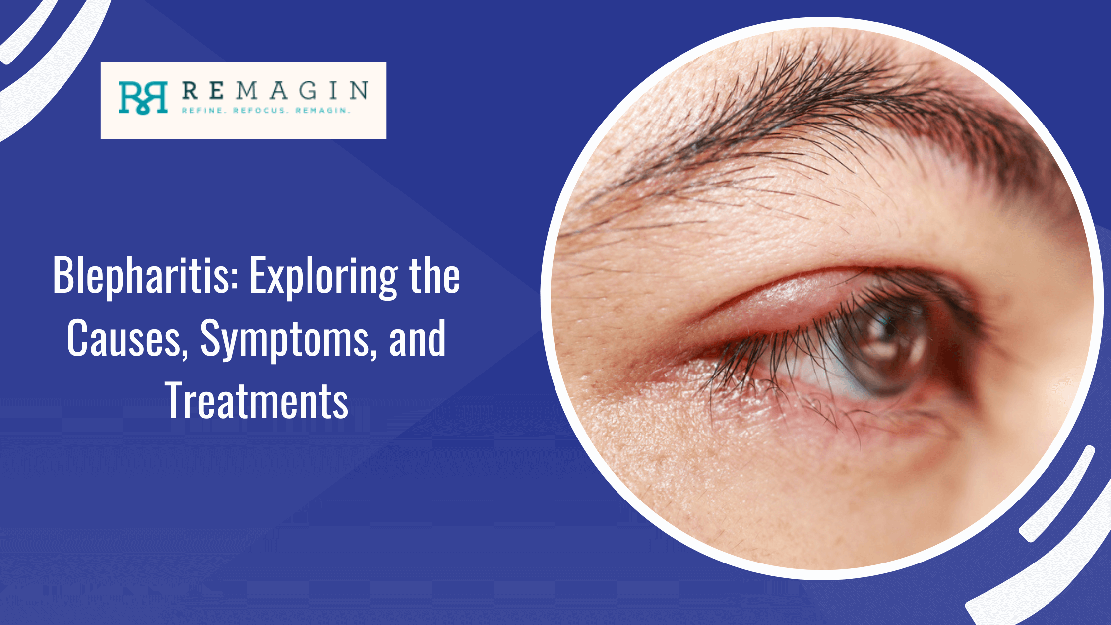 Blepharitis: Exploring the Causes, Symptoms, and Treatments