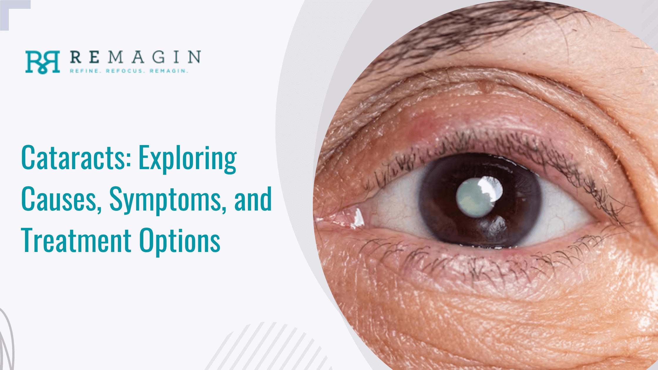 Cataracts: Exploring Causes, Symptoms, and Treatment Options