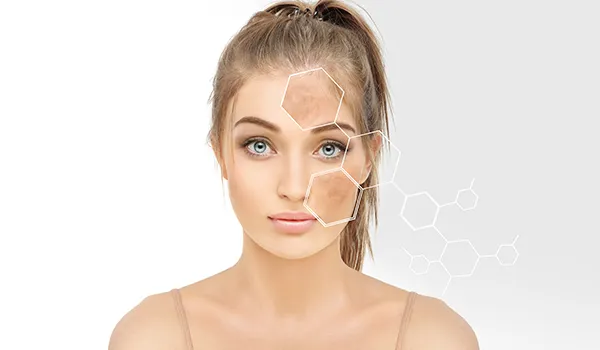 What Conditions Does a Chemical Peel Treat?