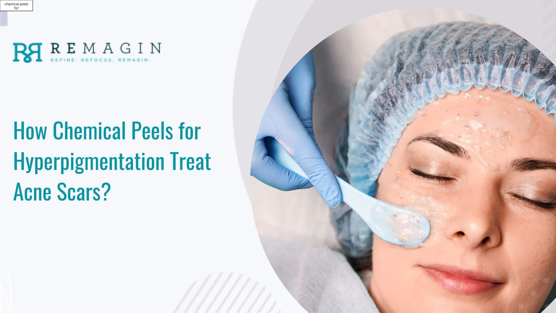 How Chemical Peels for Hyperpigmentation Treat Acne Scars?