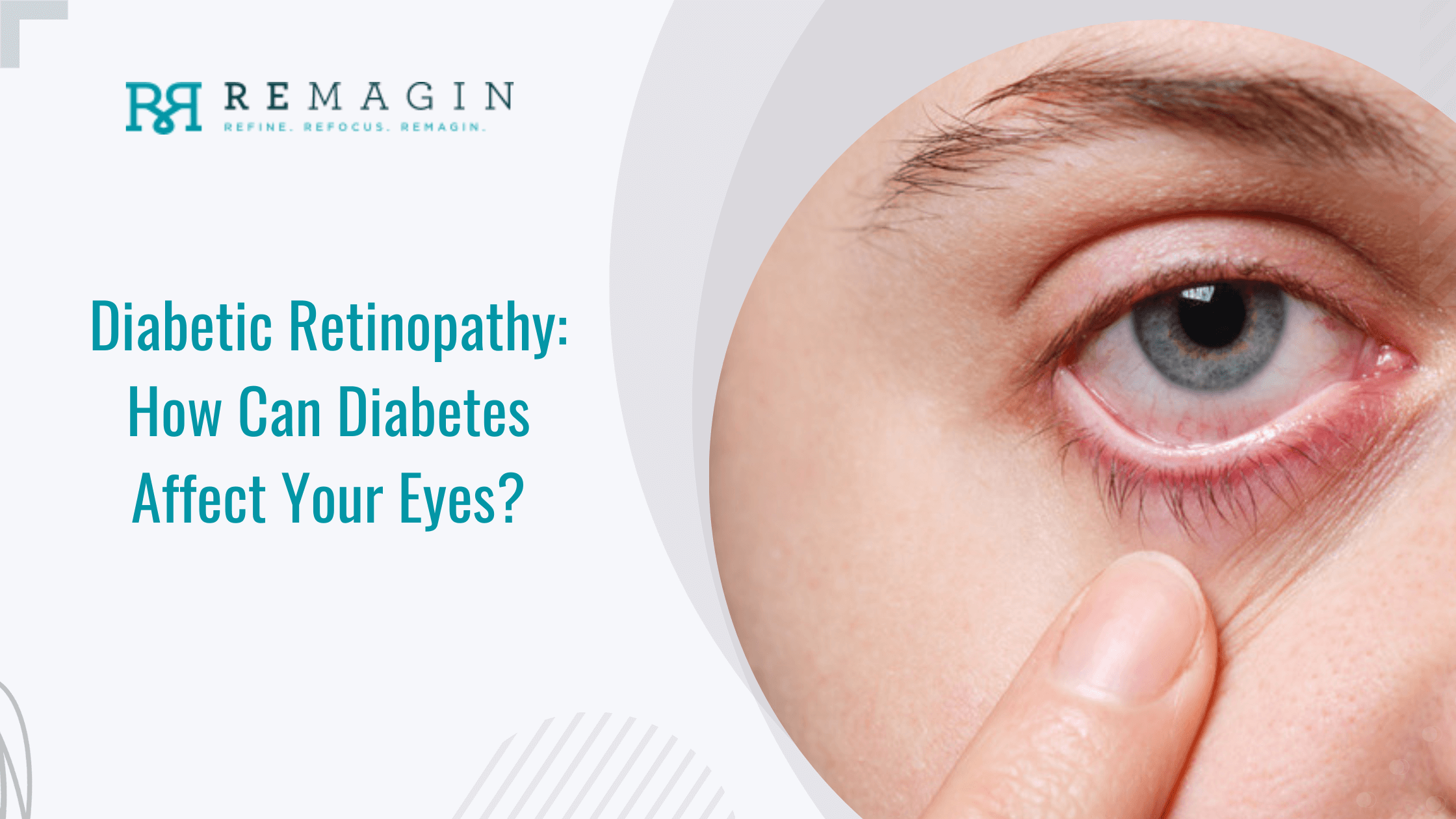 Diabetic Retinopathy: How Can Diabetes Affect Your Eyes?