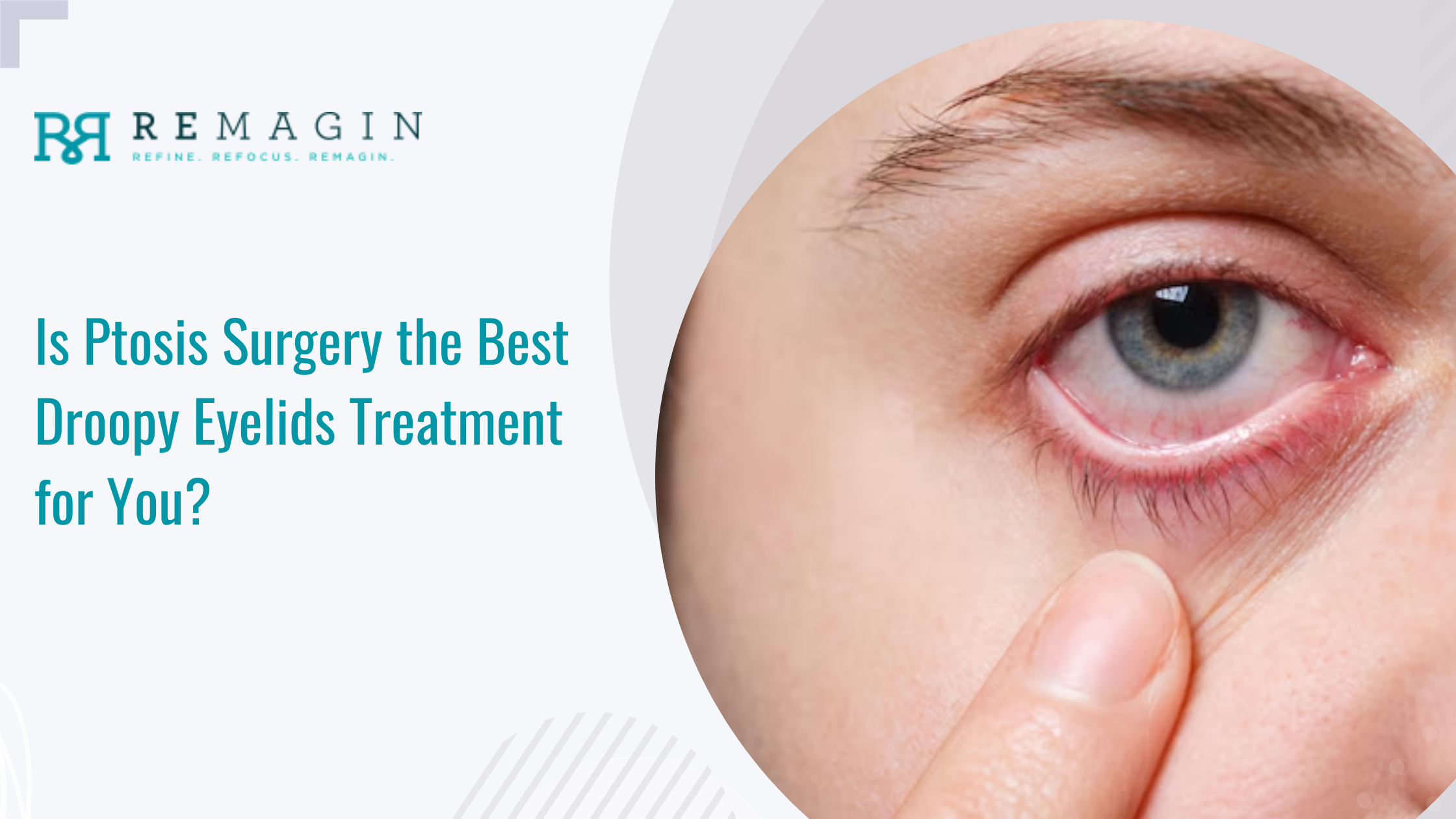 Is Ptosis Surgery the Best Droopy Eyelids Treatment for You?