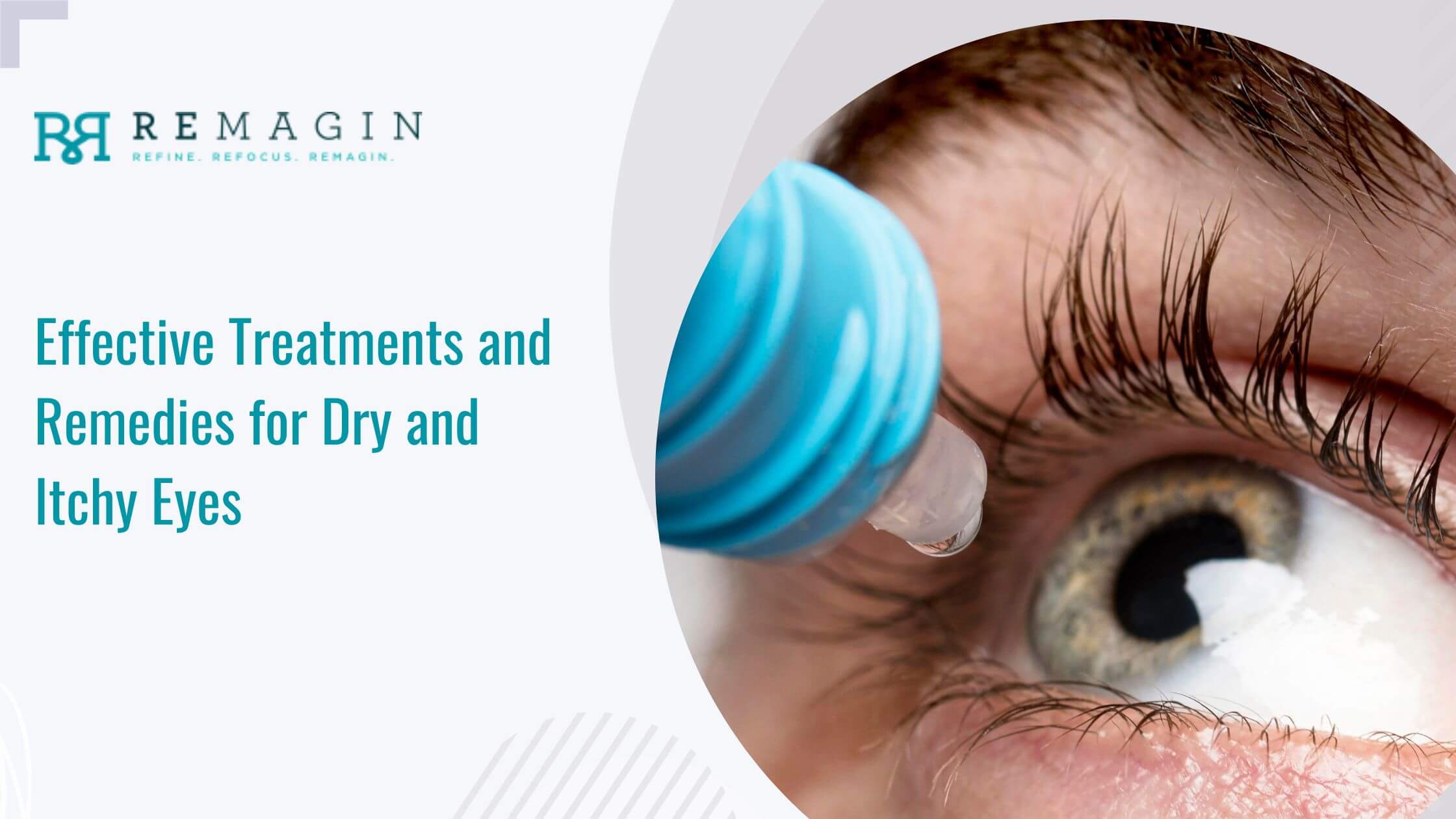 Effective Treatments and Remedies for Dry and Itchy Eyes