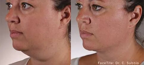 Achieve a Chiseled Jawline with FaceTite™