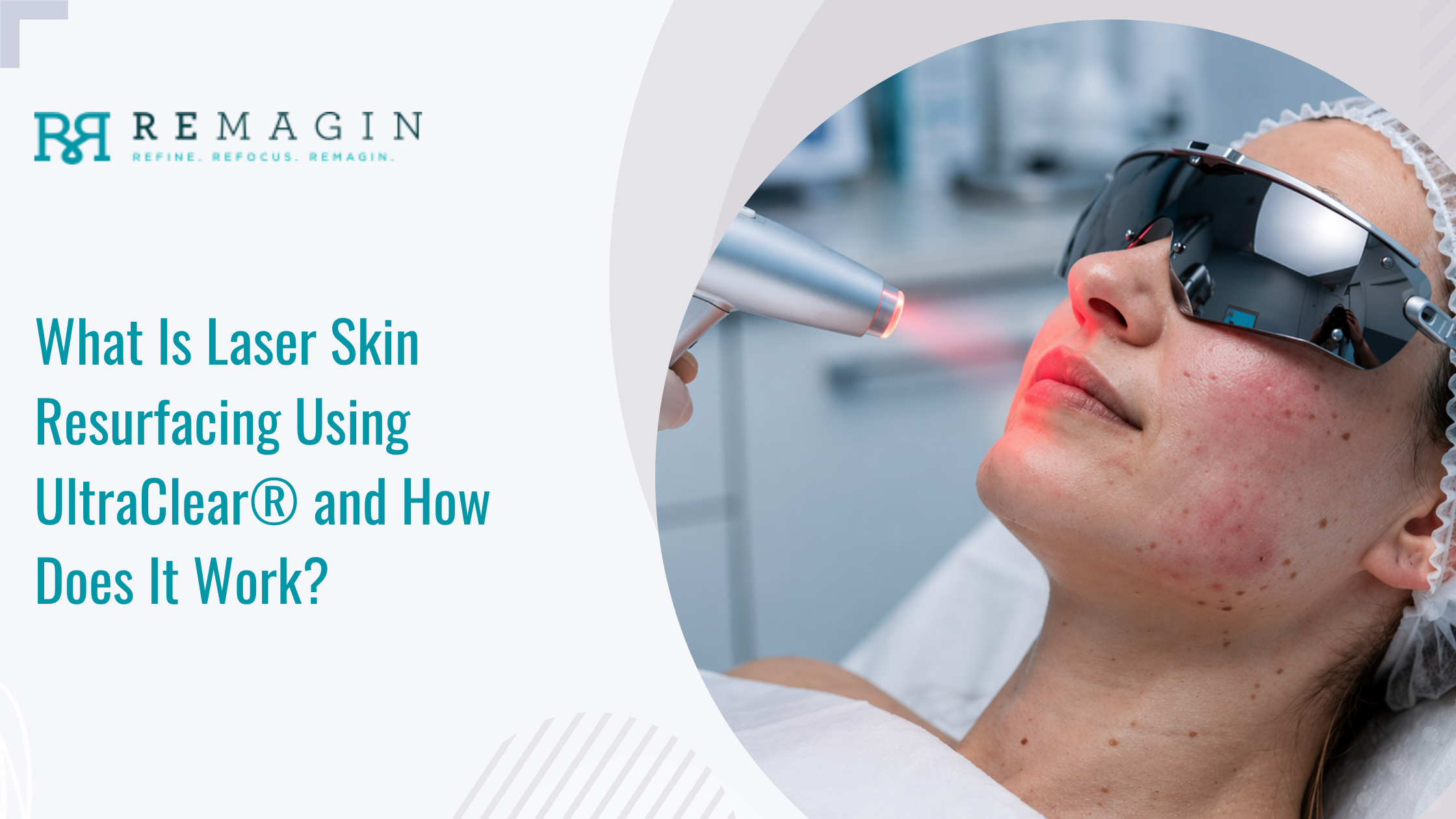 What Is Laser Skin Resurfacing Using UltraClear® and How Does It Work?