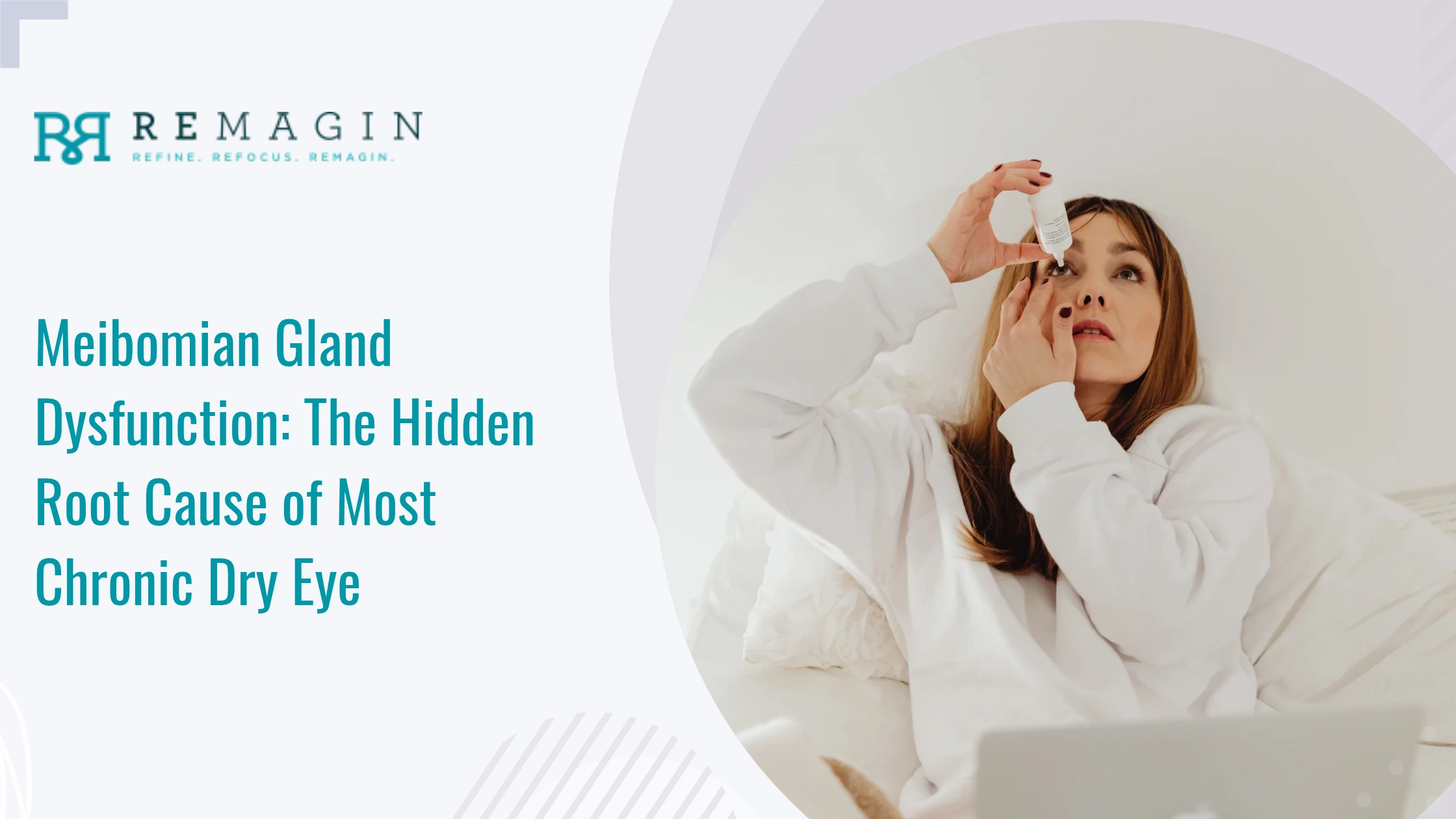 Meibomian Gland Dysfunction: The Hidden Root Cause of Most Chronic Dry Eye