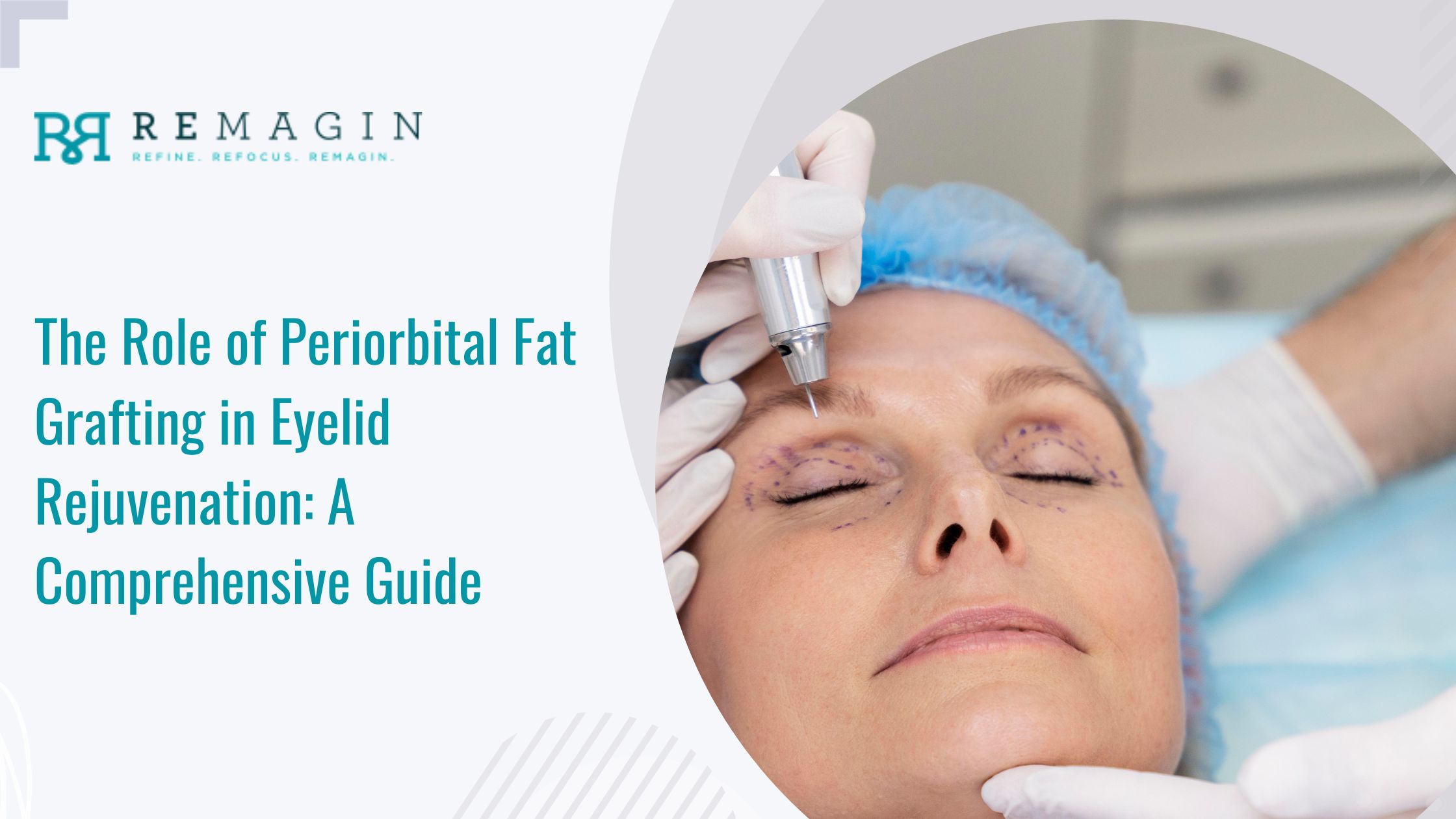 The Role of Periorbital Fat Grafting in Eyelid Rejuvenation: A ...