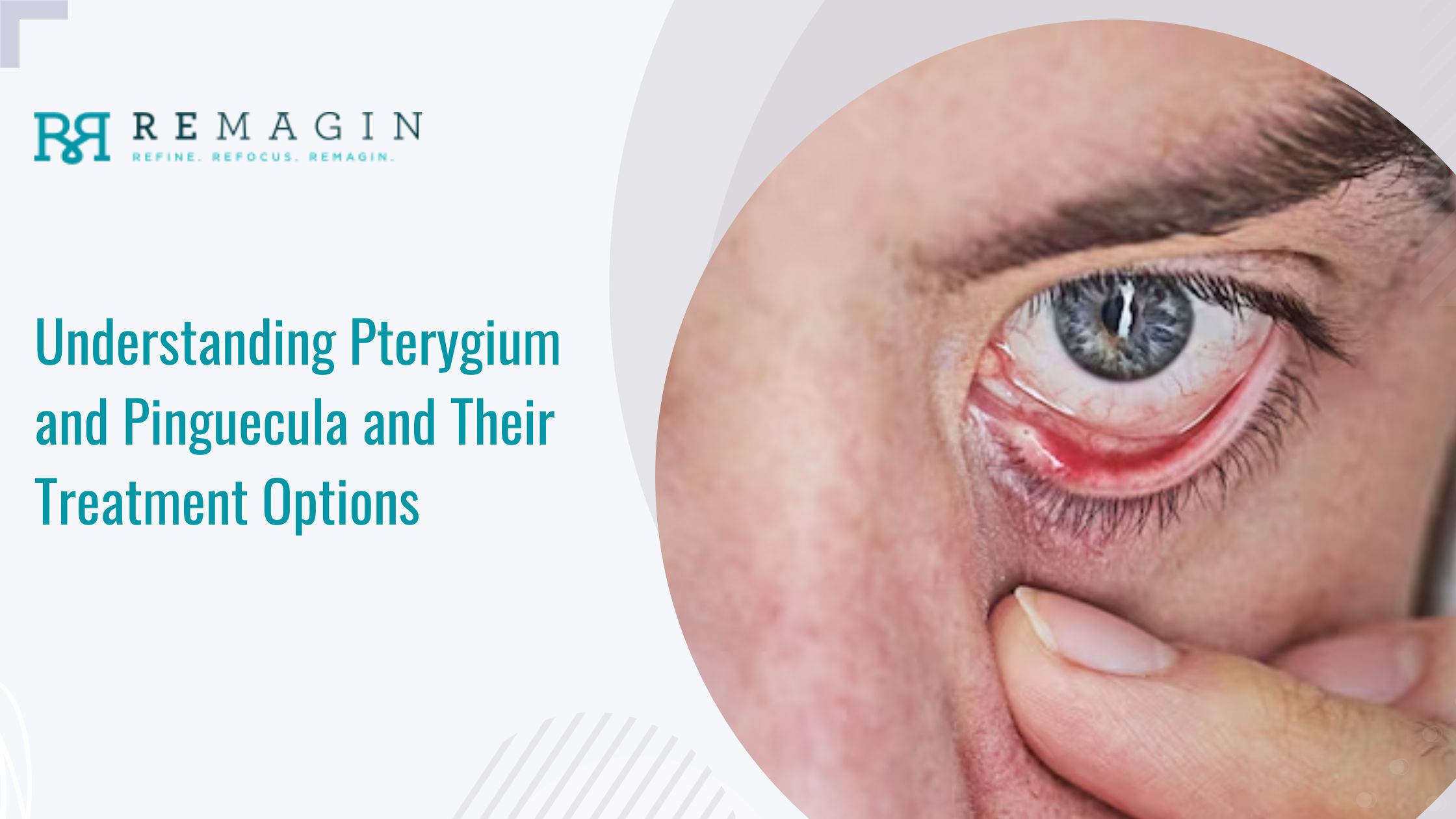 Understanding Pterygium and Pinguecula and Their Treatment Options