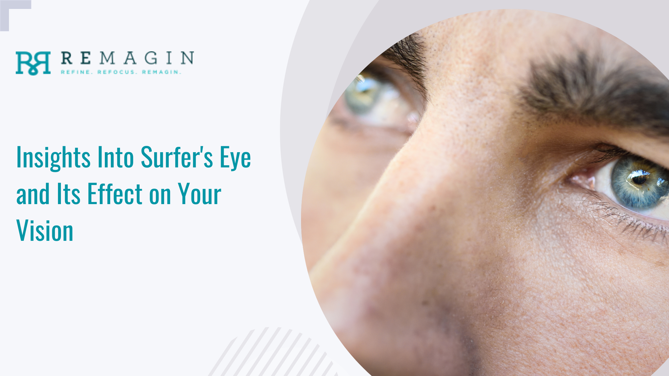 Pterygium (Surfer's Eye) Symptoms, Causes & Treatments | Remagin Eye Care