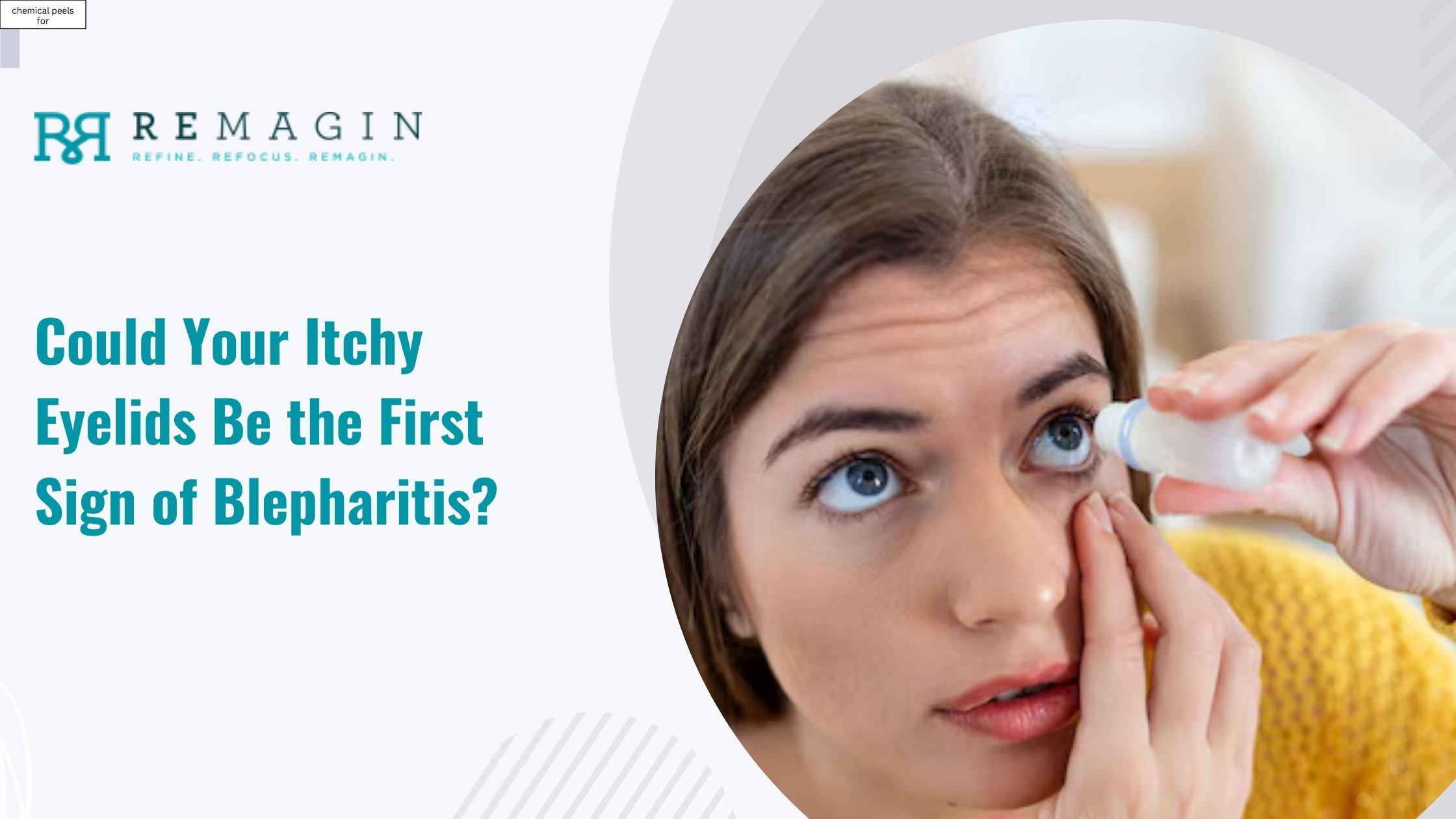 sign of blepharitis