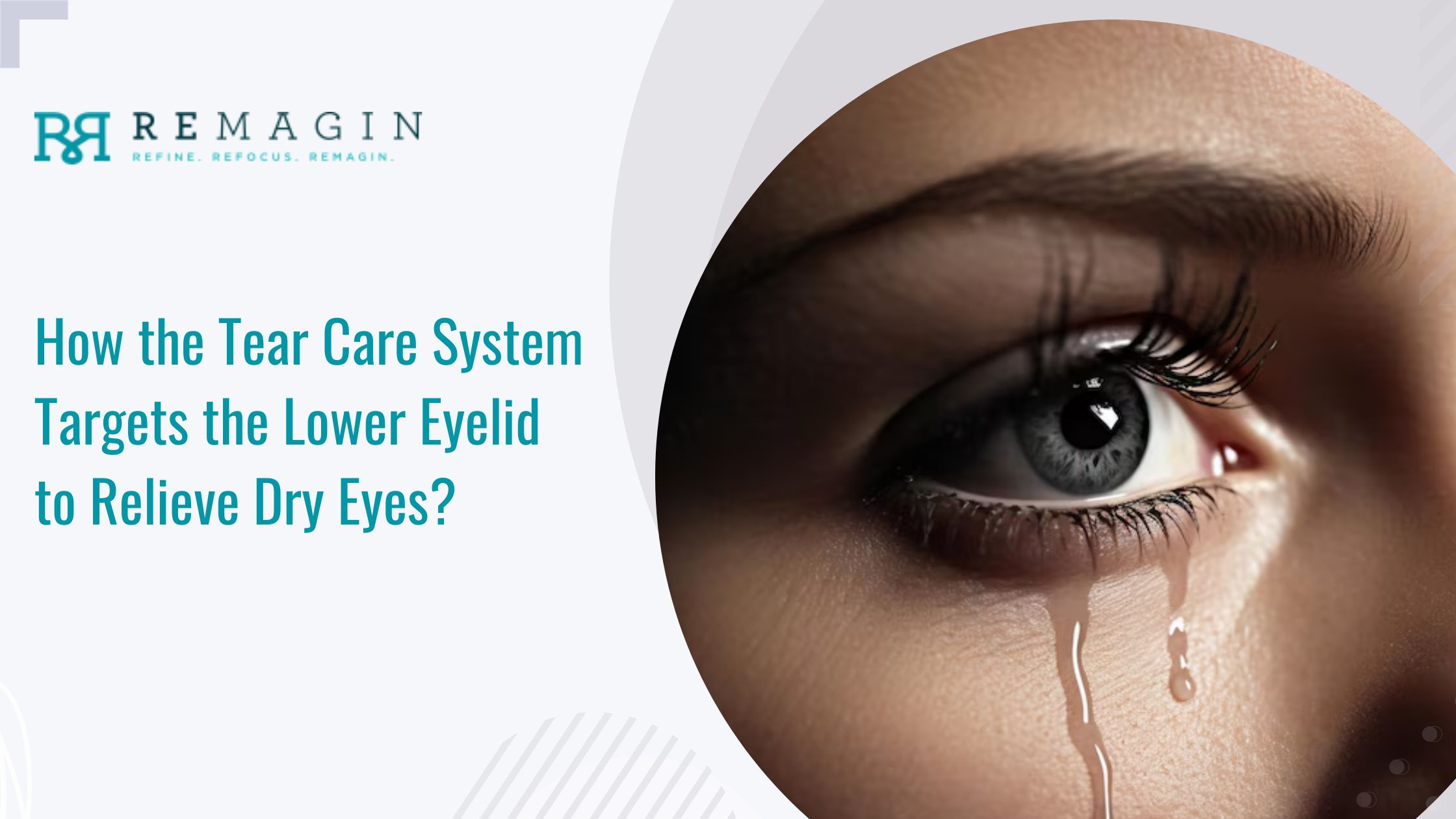 How the Tear Care System Targets the Lower Eyelid to Relieve Dry Eyes?