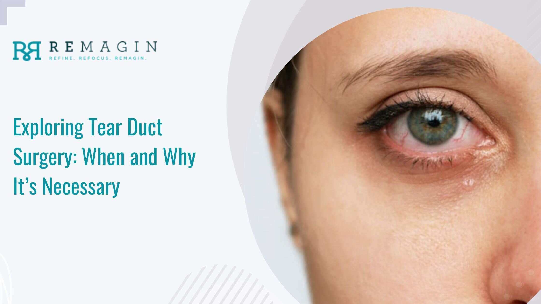 Exploring Tear Duct Surgery: When and Why It’s Necessary