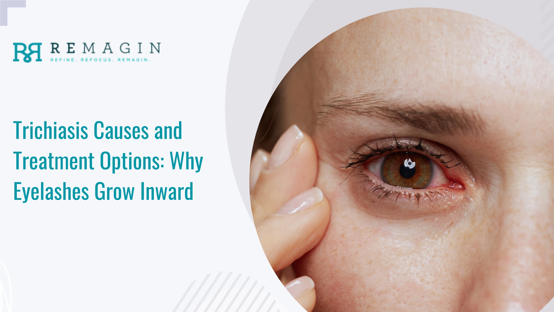 Trichiasis Causes and Treatment Options: Why Eyelashes Grow Inward