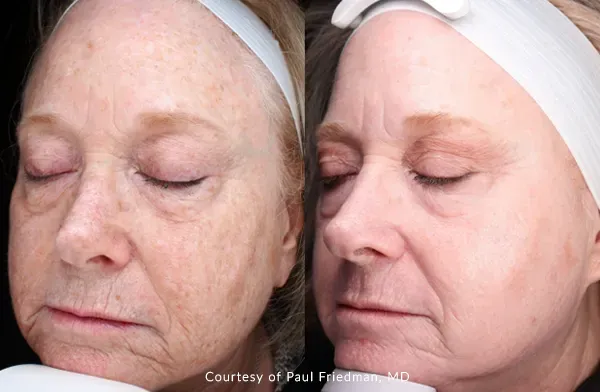 What Is Laser Skin Resurfacing with UltraClear®?