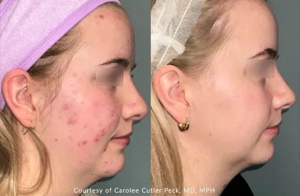 Benefits of Laser Resurfacing with UltraClear® at Remagin