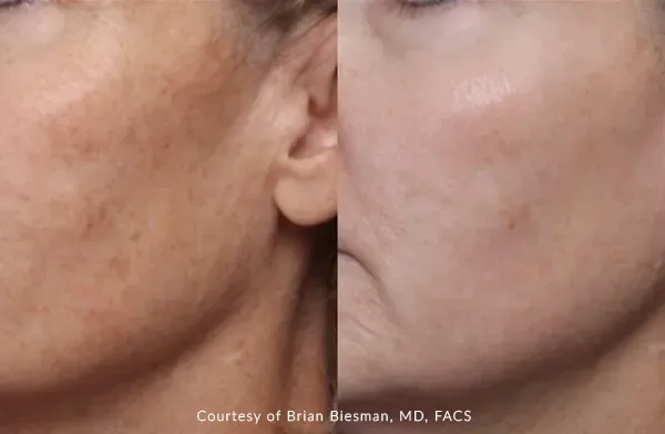 How Does UltraClear® Specifically Deliver Cold Laser Energy?