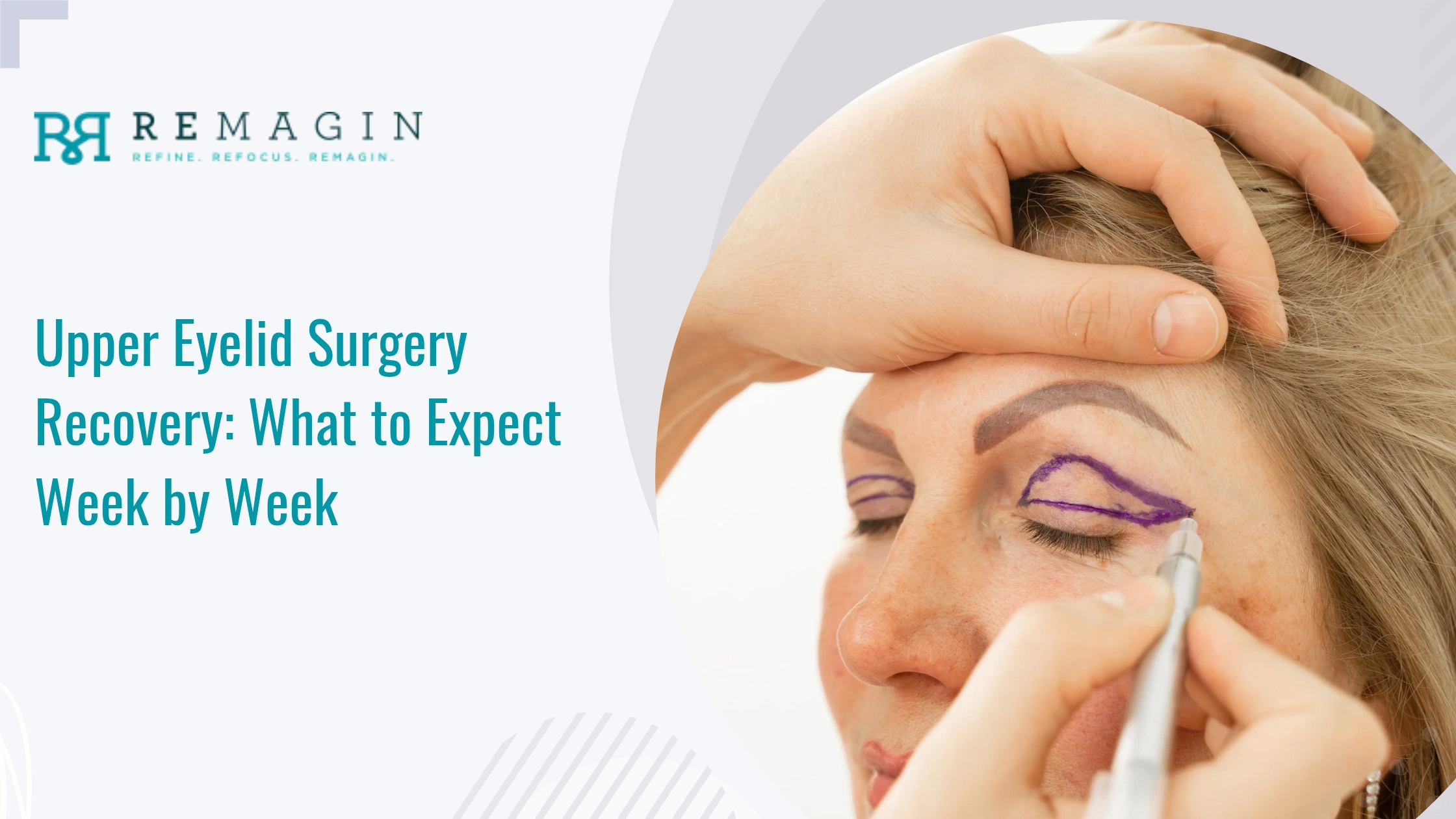 Upper Eyelid Surgery Recovery: What to Expect Week by Week