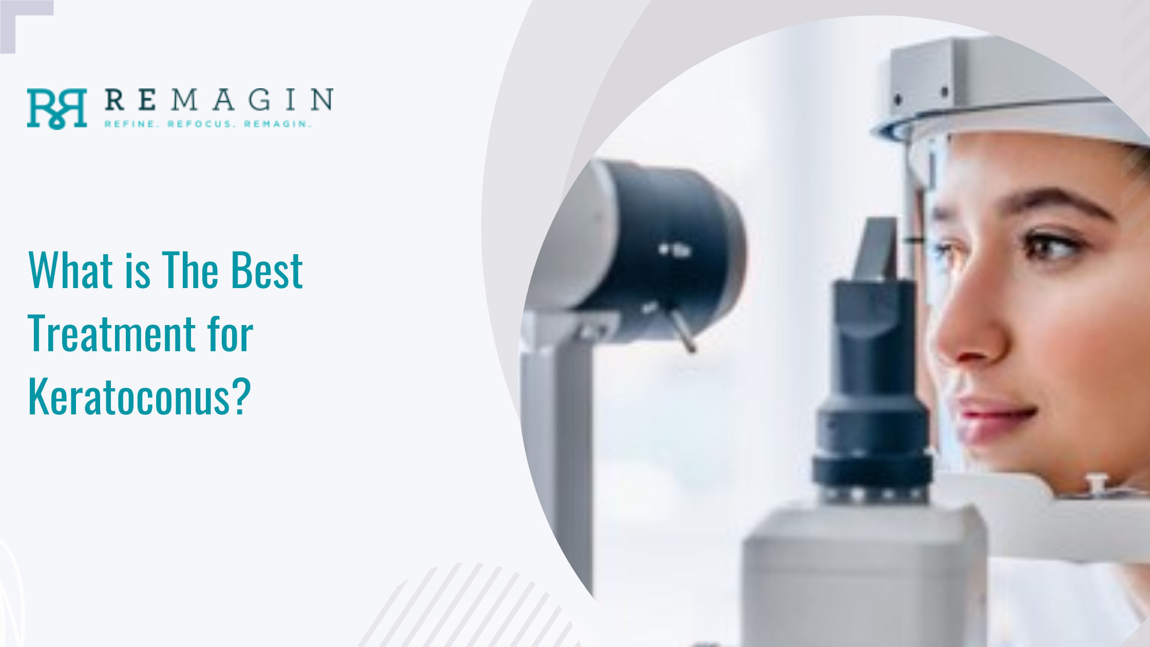 What is The Best Treatment for Keratoconus?