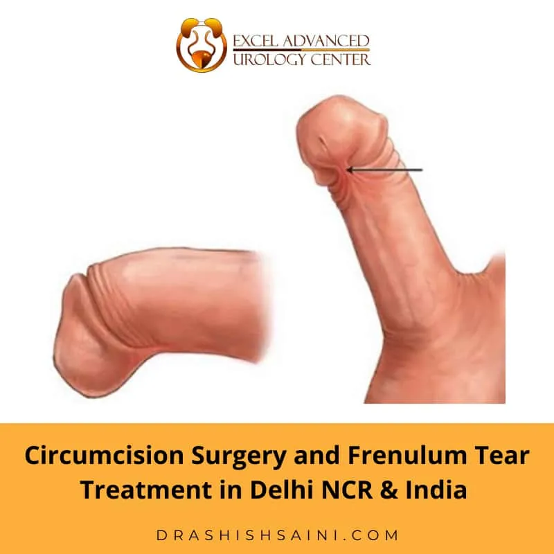 circumcision surgery in delhi