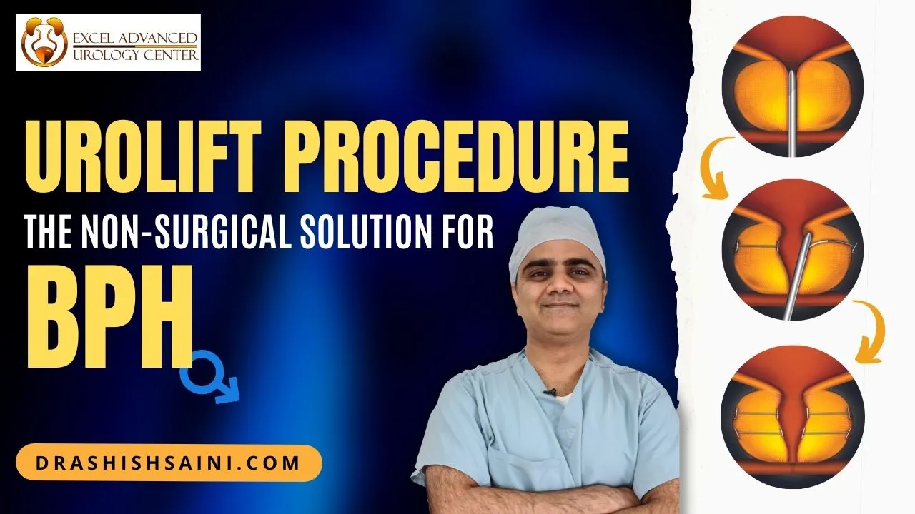 UroLift Procedure: The Non-Surgical Solution for BPH