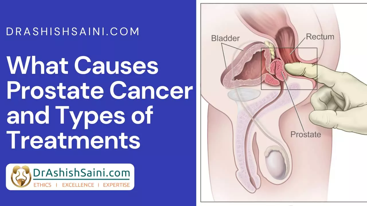 What Causes Prostate Cancer and Types of Treatments