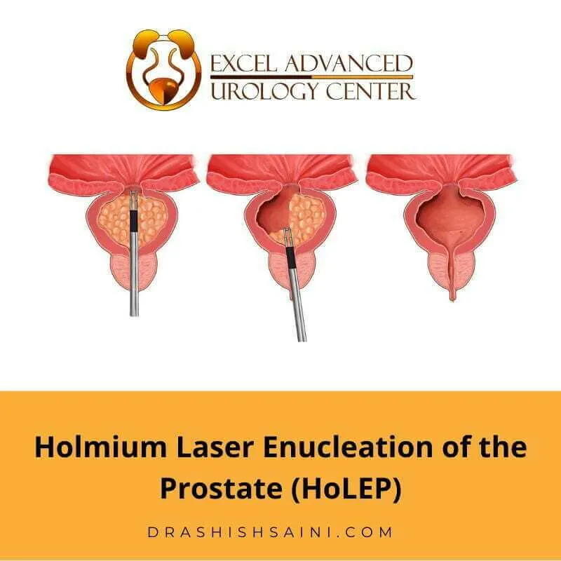 HoLEP (Holmium Laser Enucleation of the Prostate)