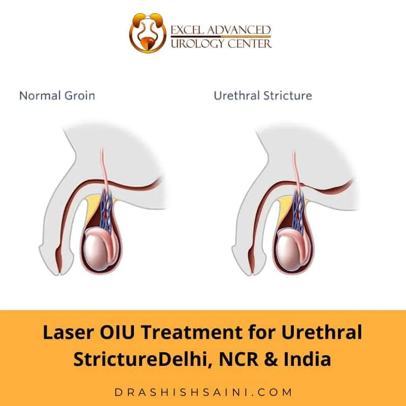 urethral stricture treatment in india