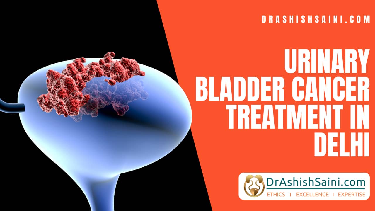 Urinary Bladder Cancer Treatment in Delhi