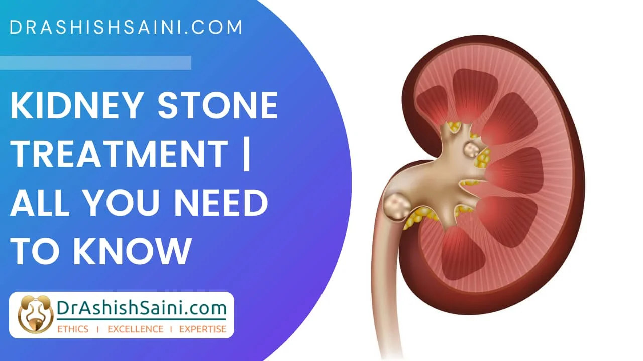 Kidney Stone Treatment | All you need to know