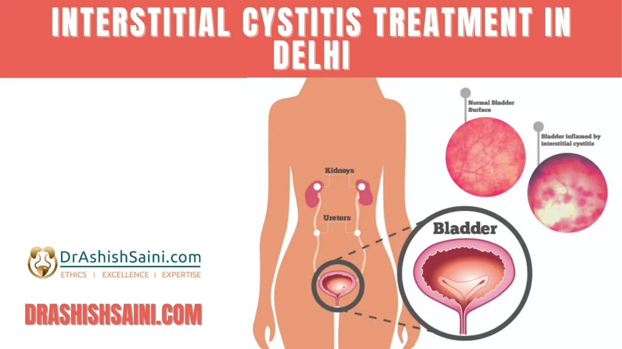 Interstitial Cystitis Treatment in Delhi