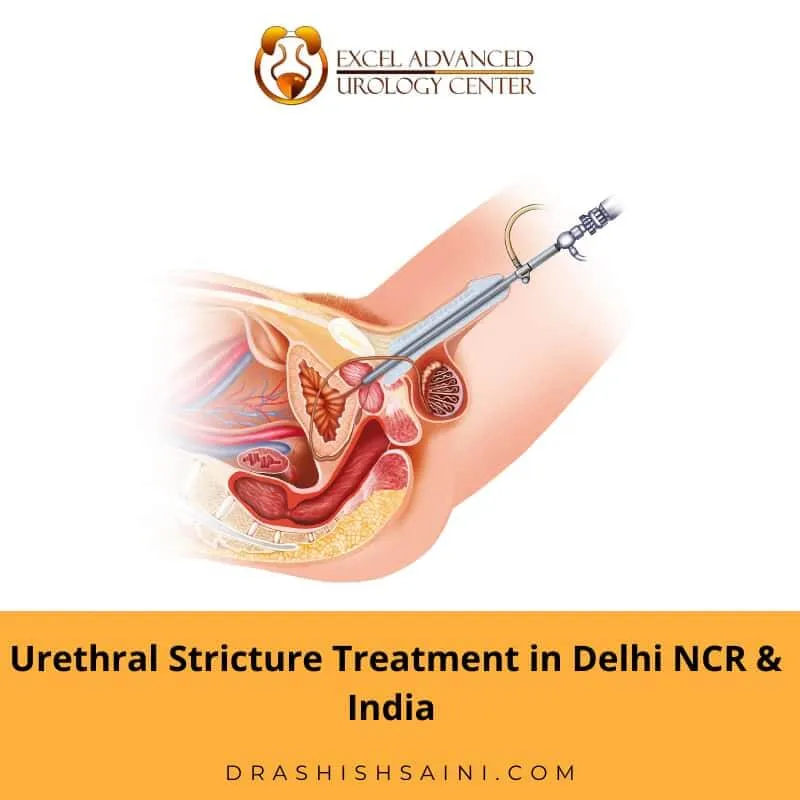 Urethral Stricture Treatment