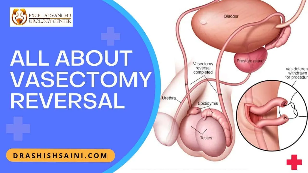 All about Vasectomy Reversal