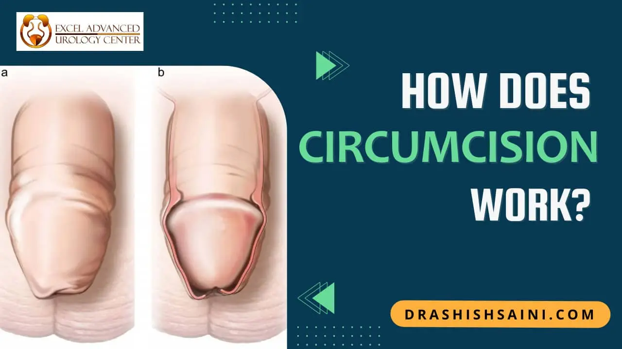 Circumcision - How does it work?