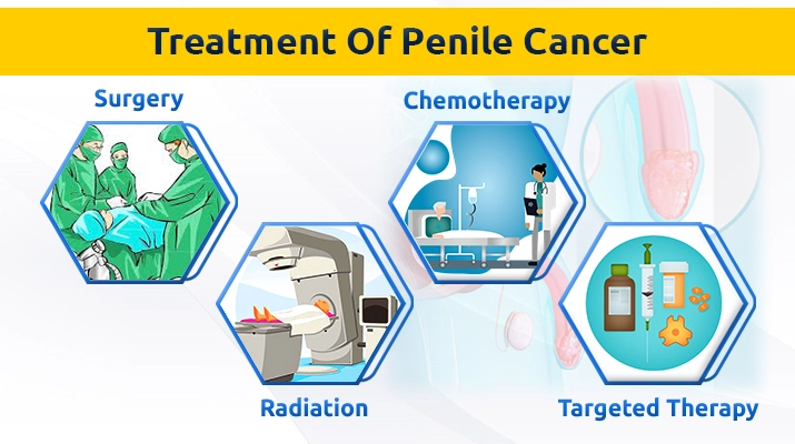 penile cancer treatment by dr ashish saini