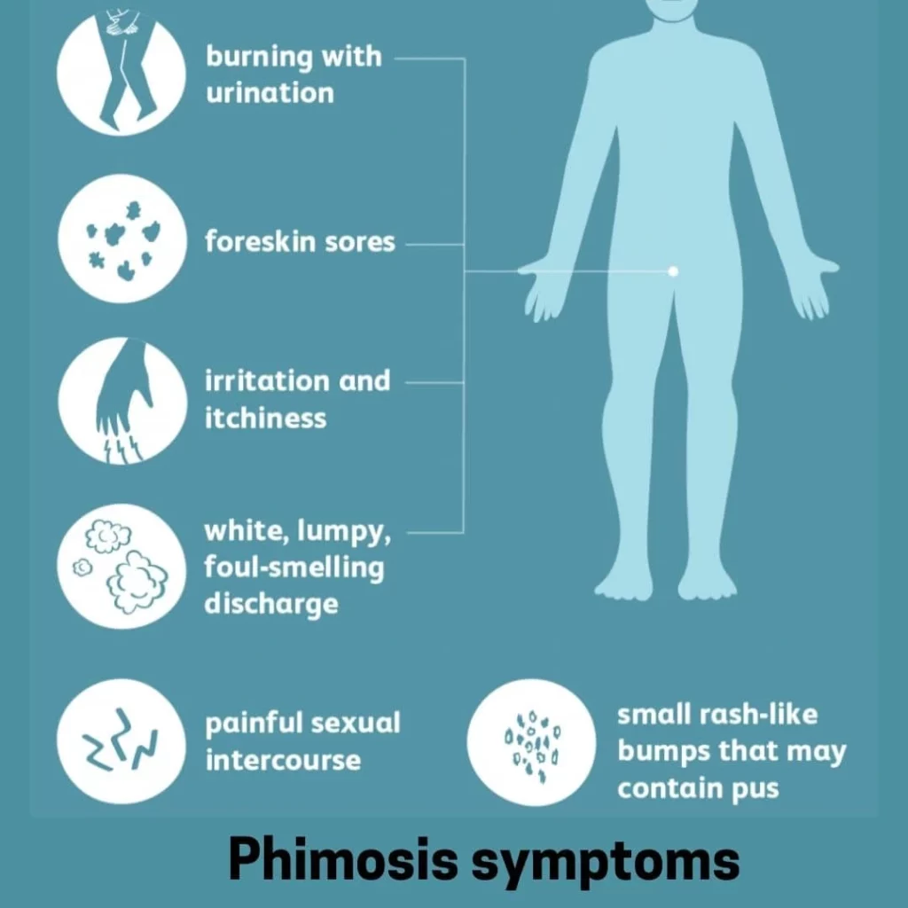 Phimosis:- Causes and Factors that lead to a Tight Foreskin