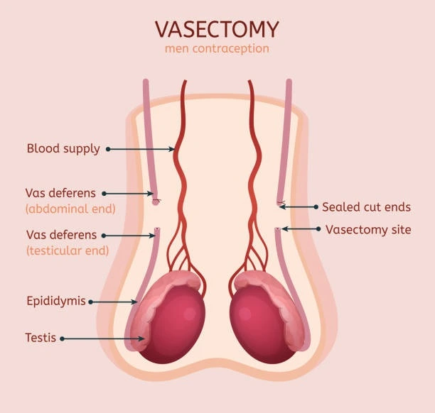 Vasectomy Reversal treatment - dr ashish saini