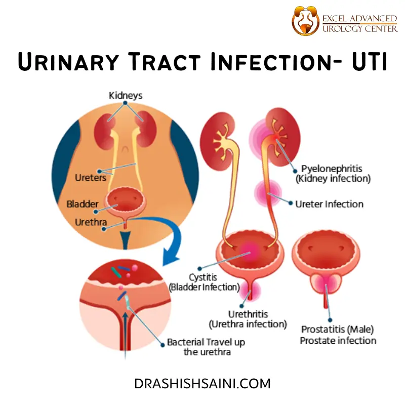 urinary tract infection treatment by dr ashish saini