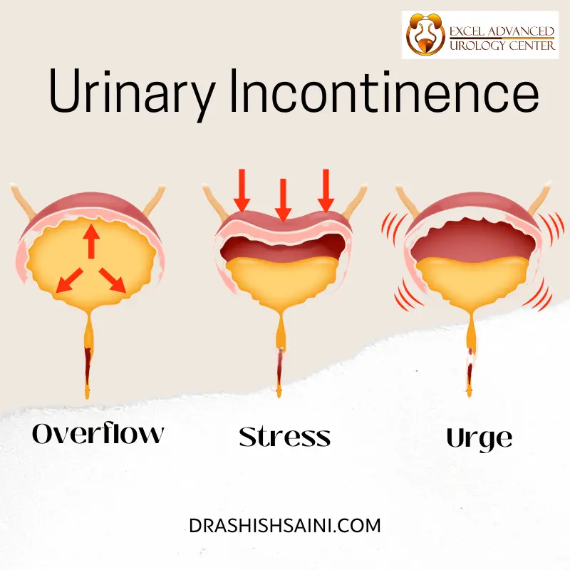 urinary incontinence treatment by dr ashish saini