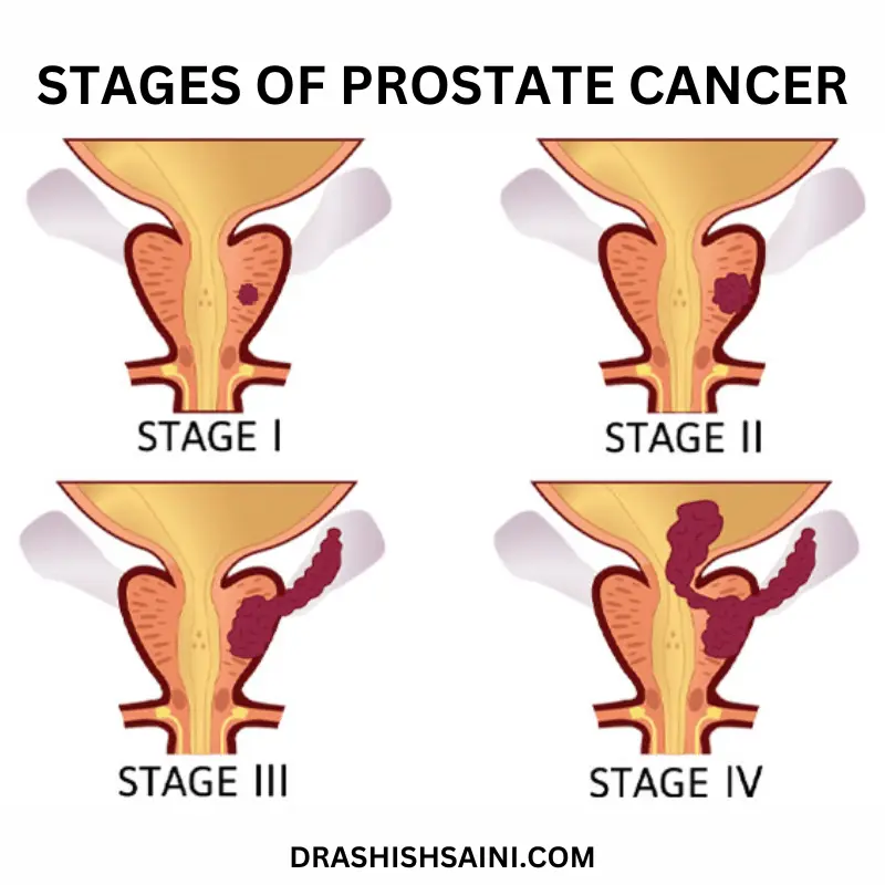 stages of prostate cancer - prostate cancer treatment by dr ashish saini