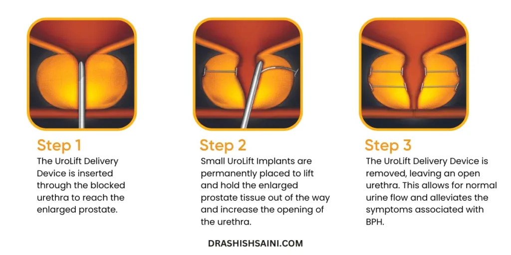 Urolift procedure by dr ashish saini