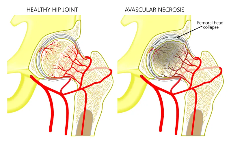 Avascular Necrosis Treatment In Mumbai Dr. Divyesh