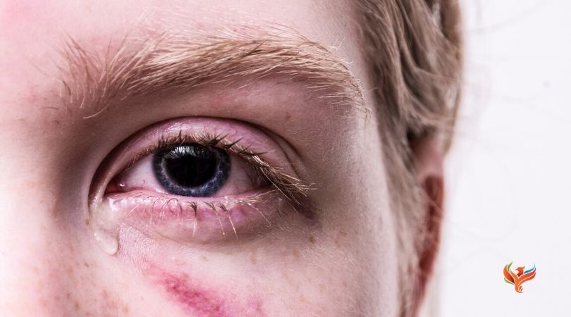 EMDR Therapy and Recent Trauma