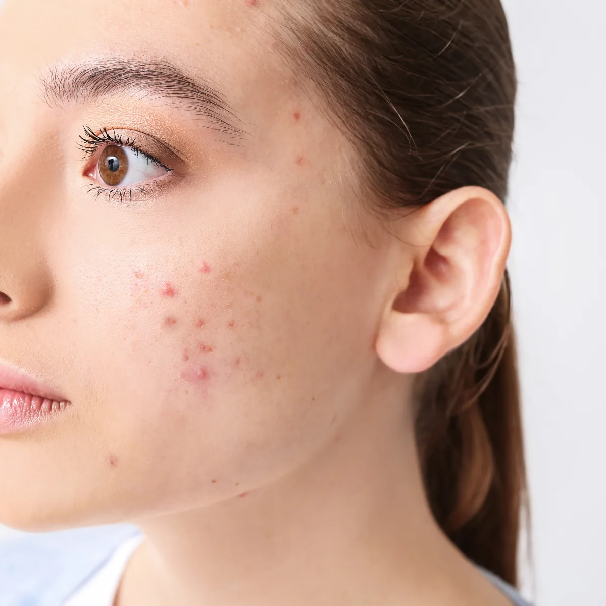 Close-up of a young woman’s cheek showing active acne breakouts