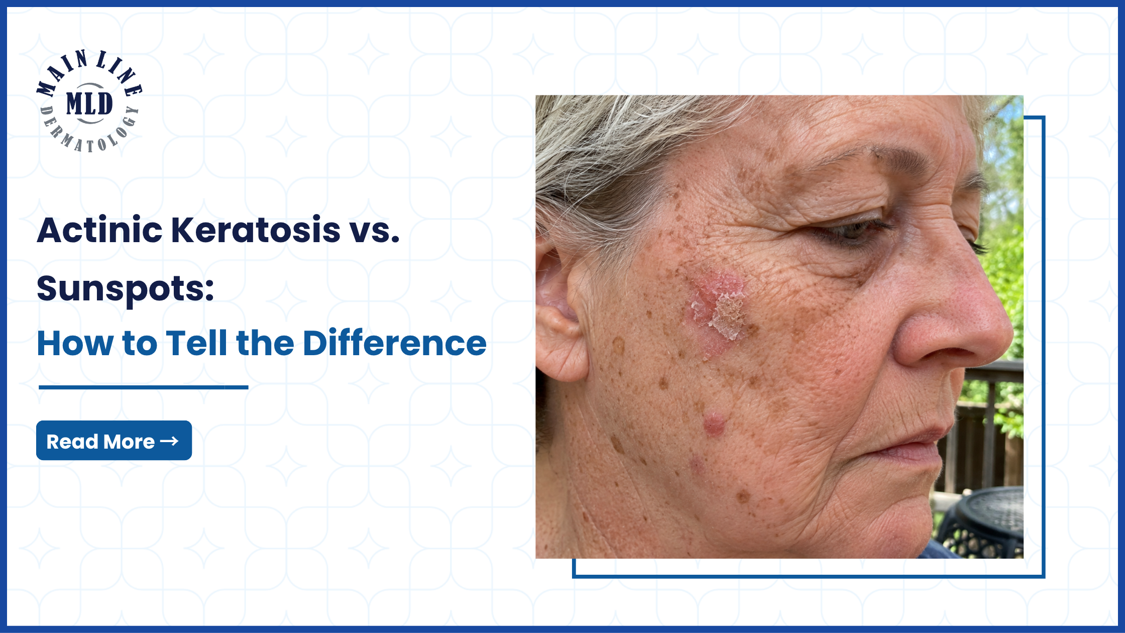 actinic keratosis vs sunspots