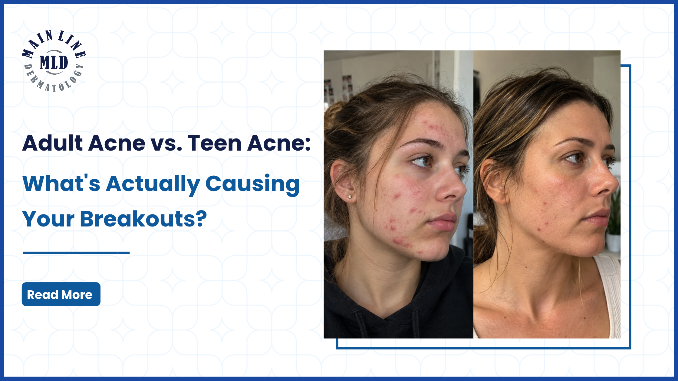 Adult Acne vs. Teen Acne 